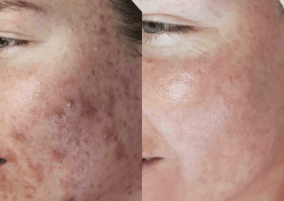 Before and after acne treatment - Cosmetic Clinic | The Mayfield Clinic by Dr. Nestor