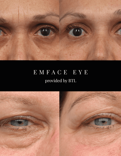 EMFace Eye Treatment, Cosmetic Clinic, Fillers Edinburgh, Botox Edinburgh | Mayfield Clinic