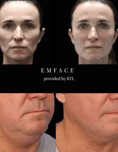 Full EMFace Treatment, Cosmetic Clinic, Cheek Fillers | Mayfield Clinic