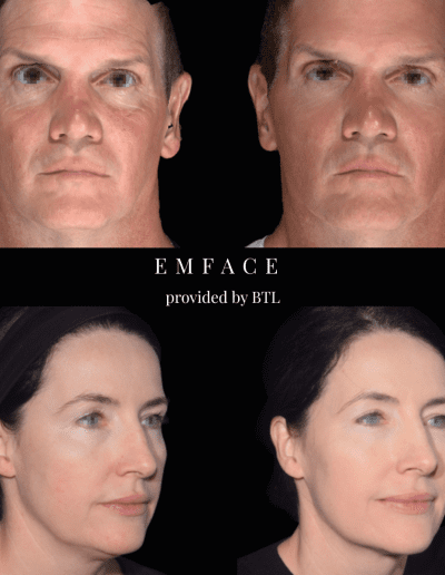 Full Face Treatment, EMFace, Cosmetic Clinic, Lip Fillers | Mayfield Clinic