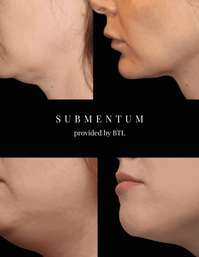 EMFace Under Chin Treatment, Cosmetic Clinic, Lip Fillers, Botox Edinburgh | Mayfield Clinic